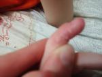 У ребёнка проблемы с пальцем и ногтем на ручке! фото 2