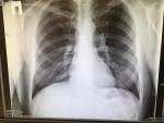 Рентген лёгких как понять что там? фото 1