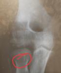 Вколоченный перелом головки лучевой кости. Минимальная амплитуда движений фото 4