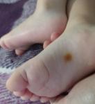 Пятно на стопе у ребенка светло коричневого цвета фото 1