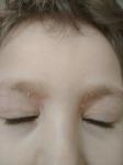 Аллергический коньюктивит, атопический дерматит (ребенок) фото 2