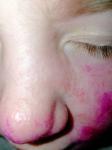 Аллергия на лице у ребёнка фото 1