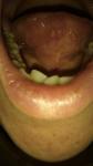 Язвы под языком с сильной болью фото 2