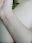 Сыпь на внутренней стороне руки от кисти до локтя фото 1