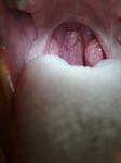 Опухоль в горле фото 3