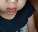 Сыпь вокруг рта у ребенка фото 2