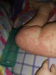 Крупная сыпь на руках и ногах у ребёнка с температурой фото 1