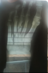 Закрытый перелом со смещение 2,3,4 пальцев левой ноги, нужно ли оперировать? фото 1