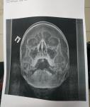 Рентген пазух носа, есть ли синусит фото 1