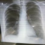 Расшифровка рентгена лёгких фото 1