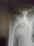 Остеома плечевой кости фото 3