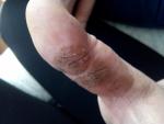 Трещины на пальце руки фото 1