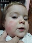Высыпание на щеках у ребенка фото 1