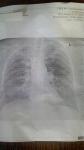 Подозрение на пневмонию, приложено описание рентгена фото 2