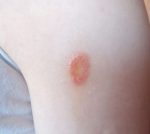 Красное пятно на предплечье фото 1