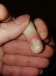 Инфекция на пальце фото 1