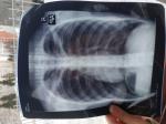 Рентген лёгких результаты фото 1