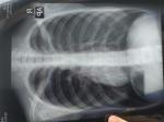 Рентген лёгких расшифровка фото 1