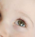 Слизистое пятно в глазу у 1,5 годовалого ребенка фото 2