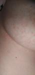 Пятношки на груди фото 1