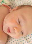 Высыпание на щеках у грудного ребенка фото 2