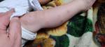 Сыпь на руках и ногах ребенок 1 год фото 3