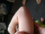 Высыпание у ребенка на руках и ногах пупырышками фото 3
