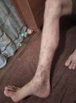 Нога варикоз фото 2