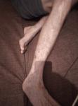 Нога варикоз фото 1