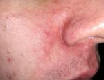 Покраснение и шелушение кожи вокруг носа фото 2