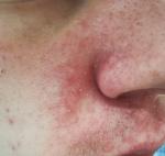 Покраснение и шелушение кожи вокруг носа фото 1