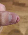 Трещина и воспаление на кончике пальца фото 3