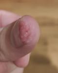 Трещина и воспаление на кончике пальца фото 2