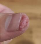 Трещина и воспаление на кончике пальца фото 1