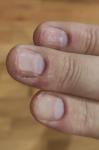 Трещина и воспаление на кончике пальца фото 4