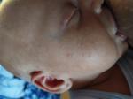 Сыпь на лице у младенца фото 3
