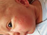 Сыпь на лице у младенца фото 1