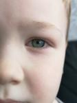 Покраснел глаз у ребёнка фото 2