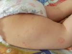 Красные пятна на ногах ребенка фото 3