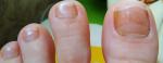 Проблема грибок или дистрофия ногтей рук и ног фото 2
