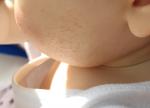 Сыпь у ребенка больше недели, усиливается фото 2