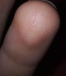 Поражения на коже пальца и они растут фото 3