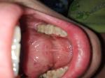 Трещины на слизистой рта под языком фото 1
