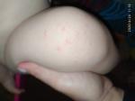 Безцветная сыпь на коленке у ребенка фото 2