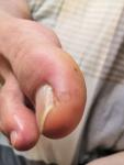 Пятна и воспаление на пальцах ног фото 1