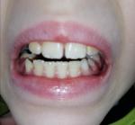 Пятна на зубах фото 1