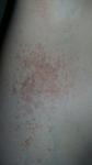 Алергия кожа фото 2
