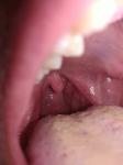 Болит горло, возможно тонзиллит, одна сторона фото 1