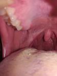 Болит горло, возможно тонзиллит, одна сторона фото 2