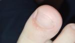 Розовое пятно на стопе, пузырьки возле ногтя пальца ноги фото 2